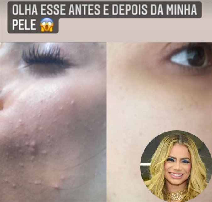 Lexa mostra antes e depois do rosto e faz alerta: <i>Ansiedade e stress acabam com a pele</i>