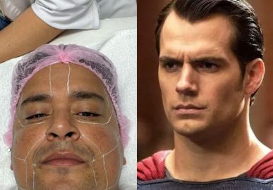 Xanddy faz procedimento estético e dispara: <I>Carla disse que vou ficar a cara do Henry Cavill</i>