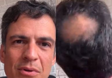 Mateus Solano assume careca e conta que não tem planos de fazer implante: <i>- Choveu proposta</i>