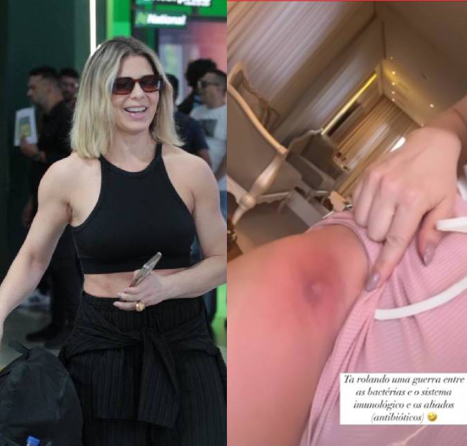 Sheila Mello mostra abscesso na perna causado por infecção bacteriana