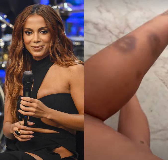 Anitta mostra hematomas na perna após tentar resgatar cachorro perdido