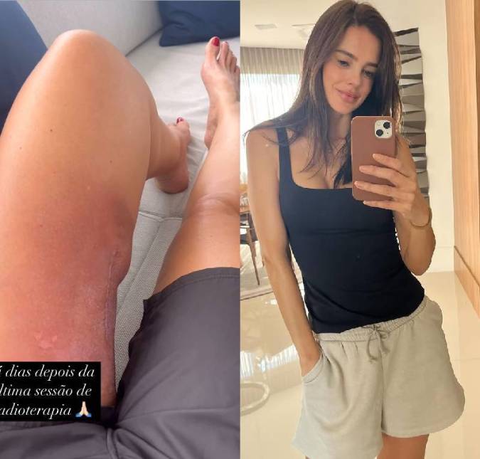 Vera Viel volta a mostrar cicatriz após 14 dias da última sessão de radioterapia. Veja tudo sobre a recuperação da ex-modelo, que retirou um tumor raro e maligno