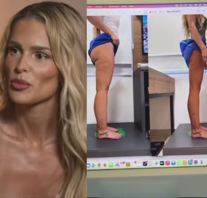 Yasmin Brunet conta que lipedema quase a tirou do <I>BBB24: Eu morro de vergonha</i>