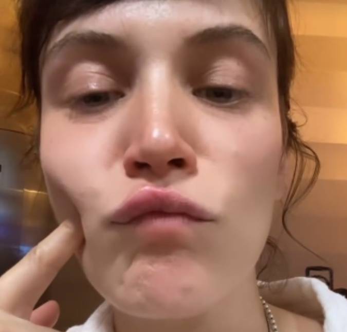 Bianca Bin mostra lábios inchados após picada: - <i>Coçando e queimando</i>