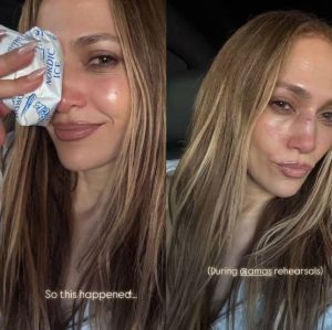 Jennifer Lopez sofre acidente durante ensaio para o <i>American Music Awards</i> e precisa levar pontos no nariz