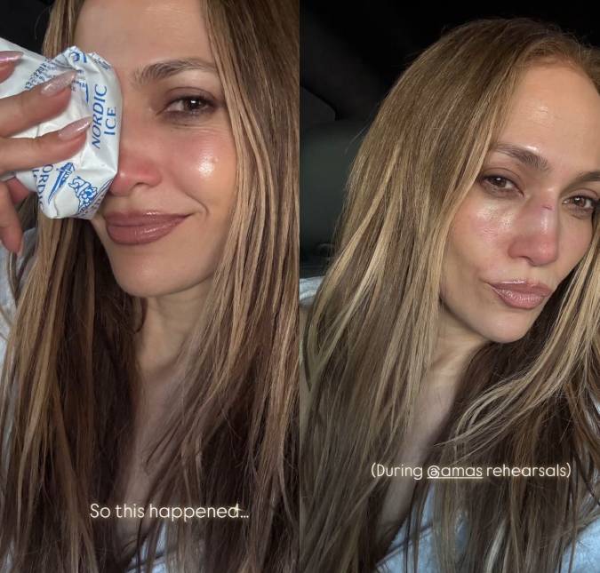 Jennifer Lopez sofre acidente durante ensaio para o <i>American Music Awards</i> e precisa levar pontos no nariz