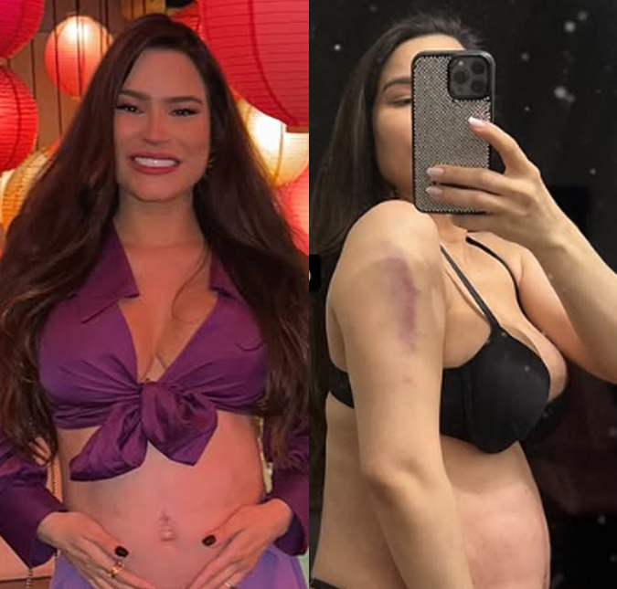 Grávida, Raissa Barbosa sofre queda da escada e fica com braço roxo: <i>Protegi a barriga</i>