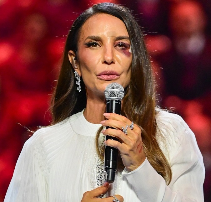 Ivete Sangalo passa por cirurgia no rosto após queda, afirma colunista