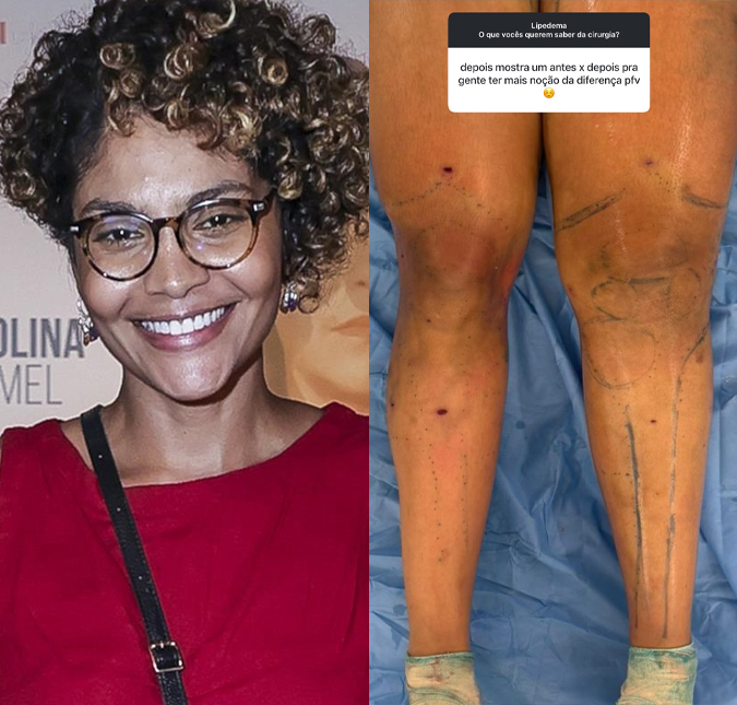 Bárbara Reis compartilha detalhes e resultado de cirurgia contra lipedema: <i>Eu só sabia chorar de alegria e emoção</i>