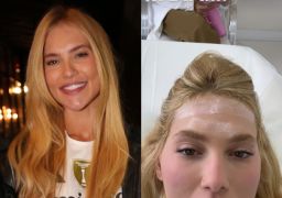 Após realizar laser íntimo, Virginia Fonseca passa por tratamento para enxaqueca com mais de 30 agulhadas